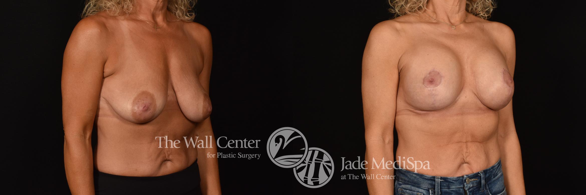 Before & After Breast Augmentation with Lift Case 1215 Right Oblique View in Shreveport, LA