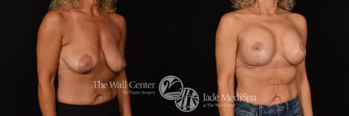 Before & After Breast Augmentation with Lift Case 1215 Right Oblique View in Shreveport, LA