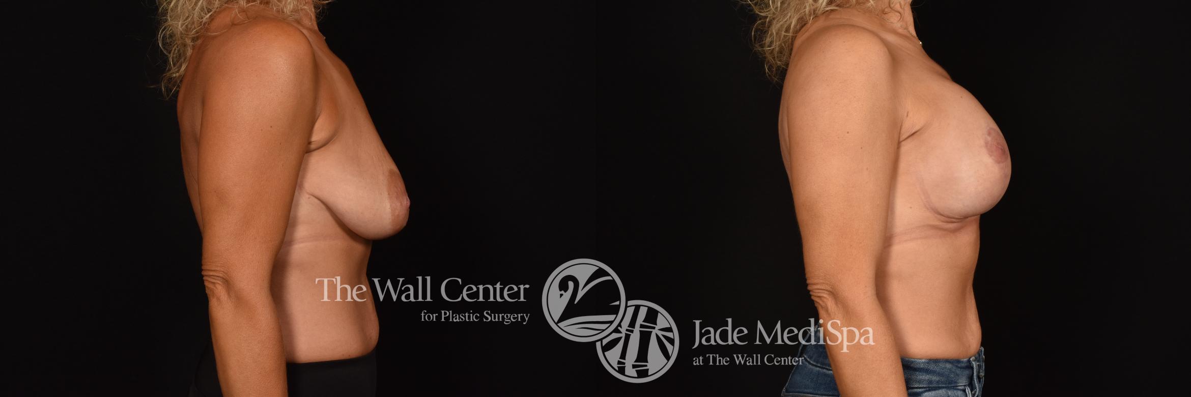 Before & After Breast Augmentation with Lift Case 1215 Right Side View in Shreveport, LA