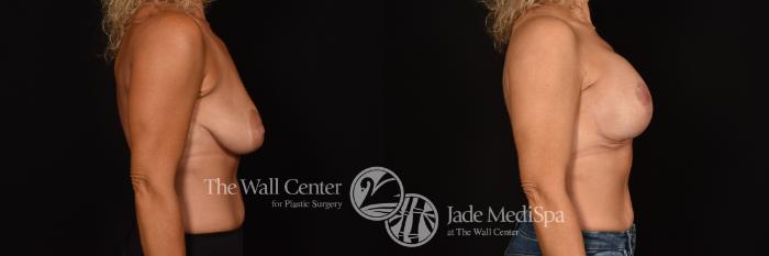 Before & After Breast Augmentation with Lift Case 1215 Right Side View in Shreveport, LA