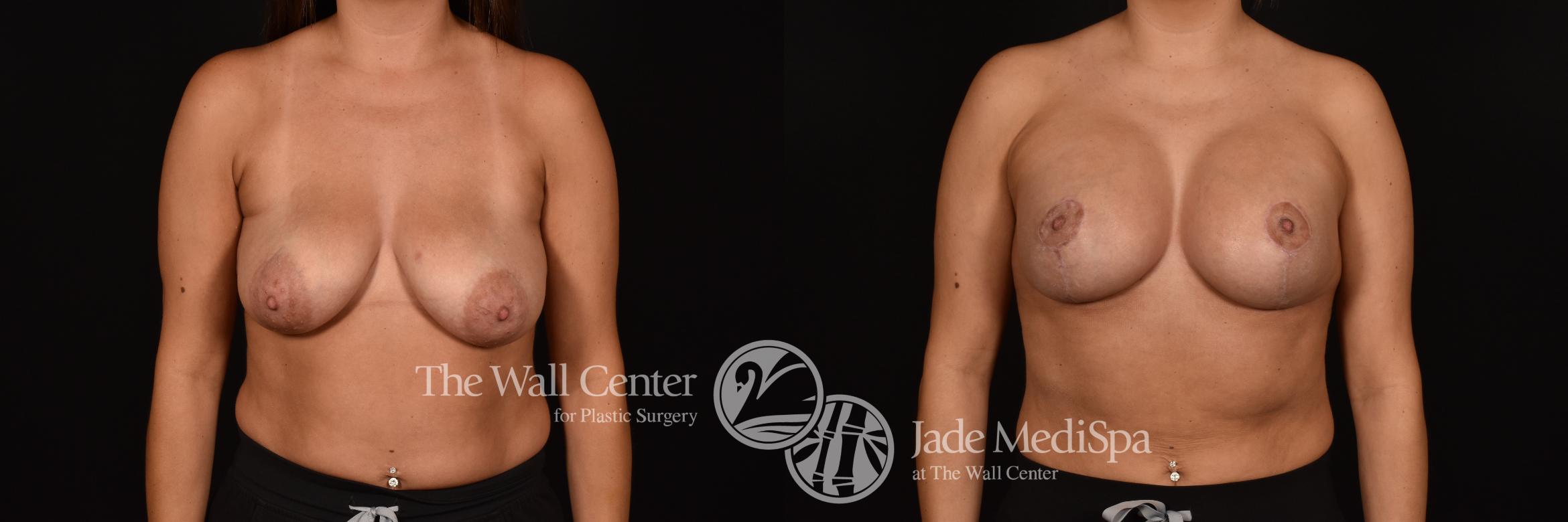 Before & After Breast Augmentation with Lift Case 1223 Front View in Shreveport, LA