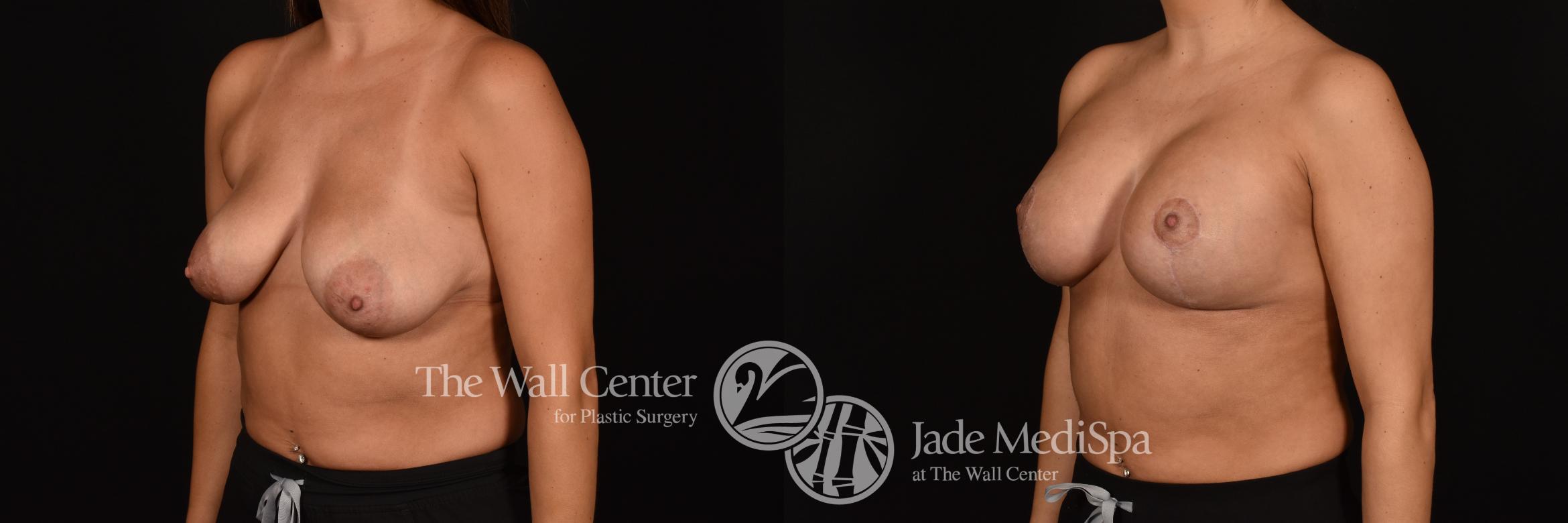 Before & After Breast Augmentation with Lift Case 1223 Left Oblique View in Shreveport, LA