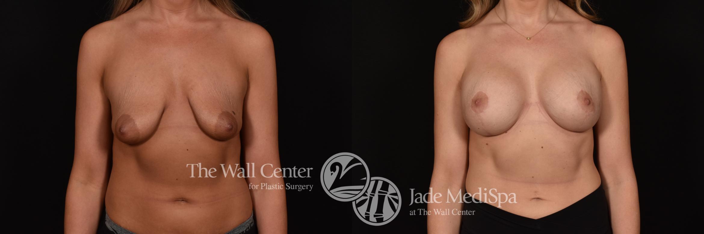Before & After Breast Augmentation with Lift Case 1225 Front View in Shreveport, LA