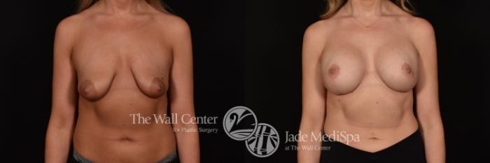 Before & After Breast Augmentation with Lift Case 1225 Front View in Shreveport, LA