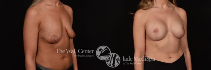Before & After Breast Augmentation with Lift Case 1225 Right Oblique View in Shreveport, LA