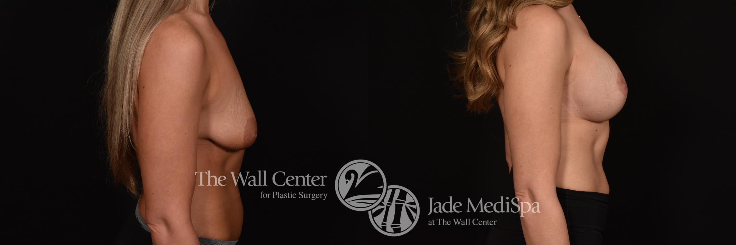 Before & After Breast Augmentation with Lift Case 1225 Right Side View in Shreveport, LA