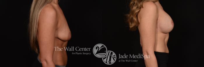 Before & After Breast Augmentation with Lift Case 1225 Right Side View in Shreveport, LA