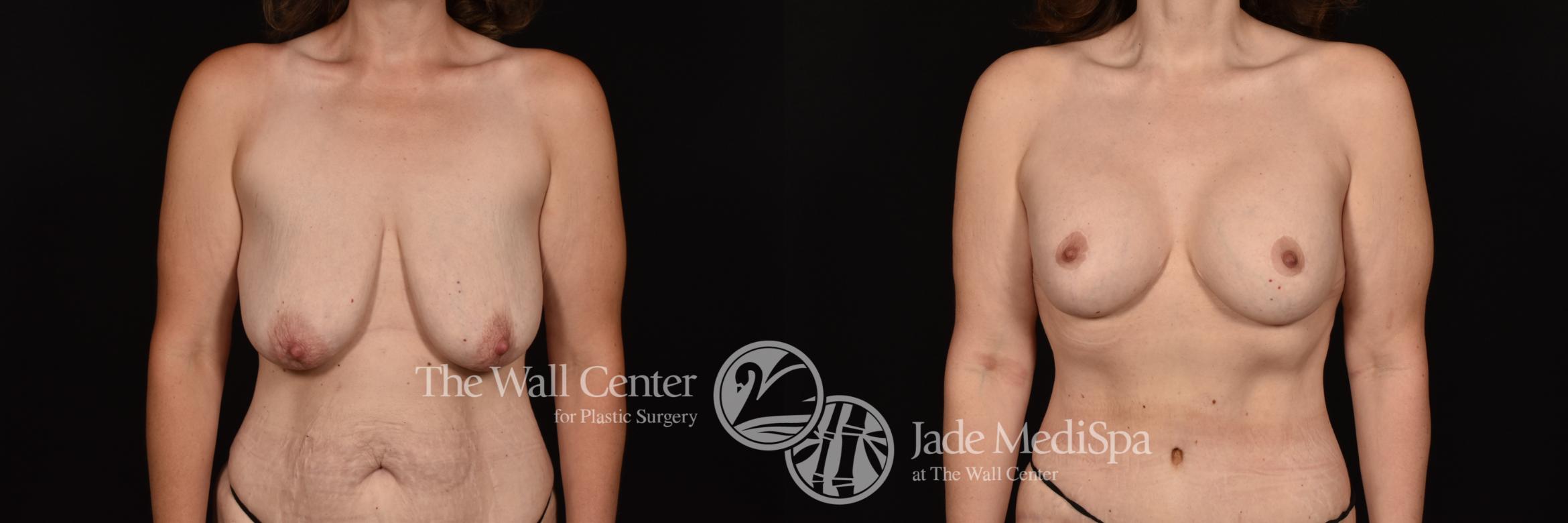 Before & After Breast Augmentation with Lift Case 1237 Front View in Shreveport, LA