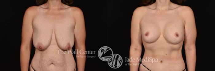 Before & After Breast Augmentation with Lift Case 1237 Front View in Shreveport, LA