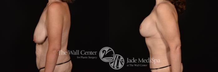 Before & After Breast Augmentation with Lift Case 1237 Left Side View in Shreveport, LA