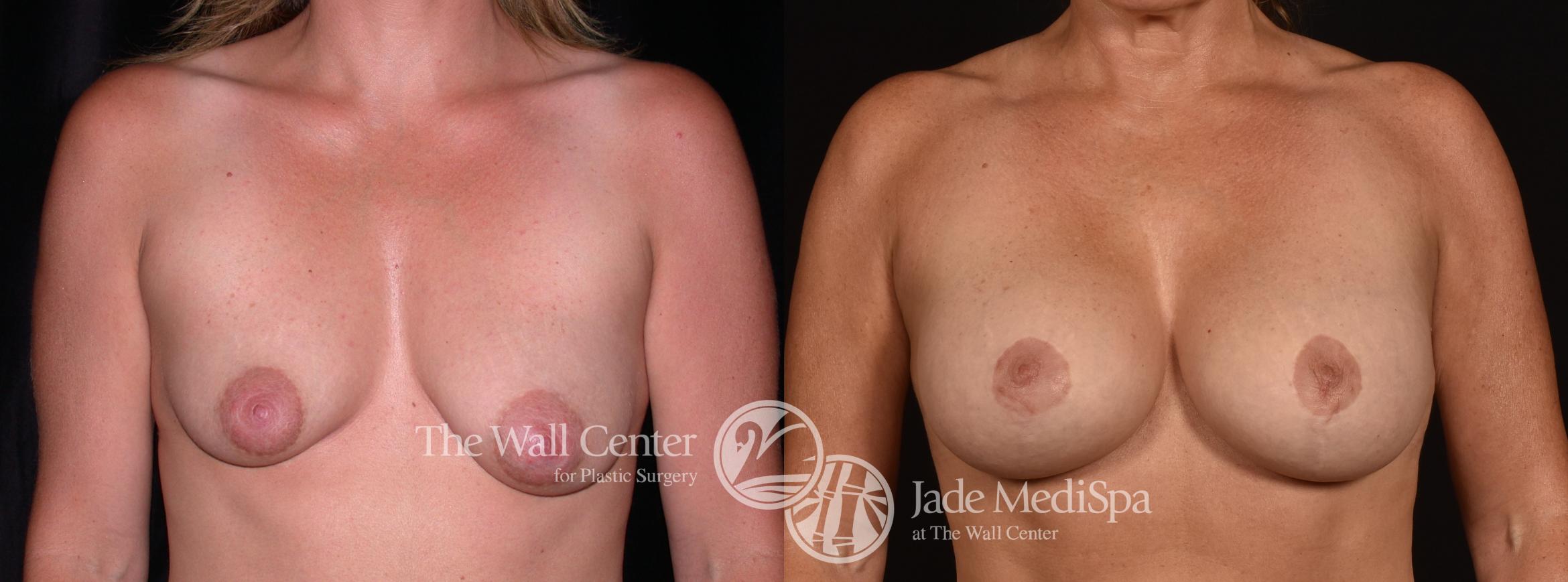 Before & After Breast Augmentation with Lift Case 1240 Front View in Shreveport, LA