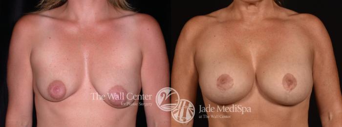 Before & After Breast Augmentation with Lift Case 1240 Front View in Shreveport, LA
