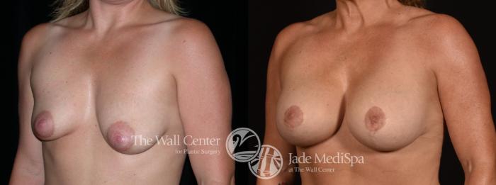 Before & After Breast Augmentation with Lift Case 1240 Left Oblique View in Shreveport, LA