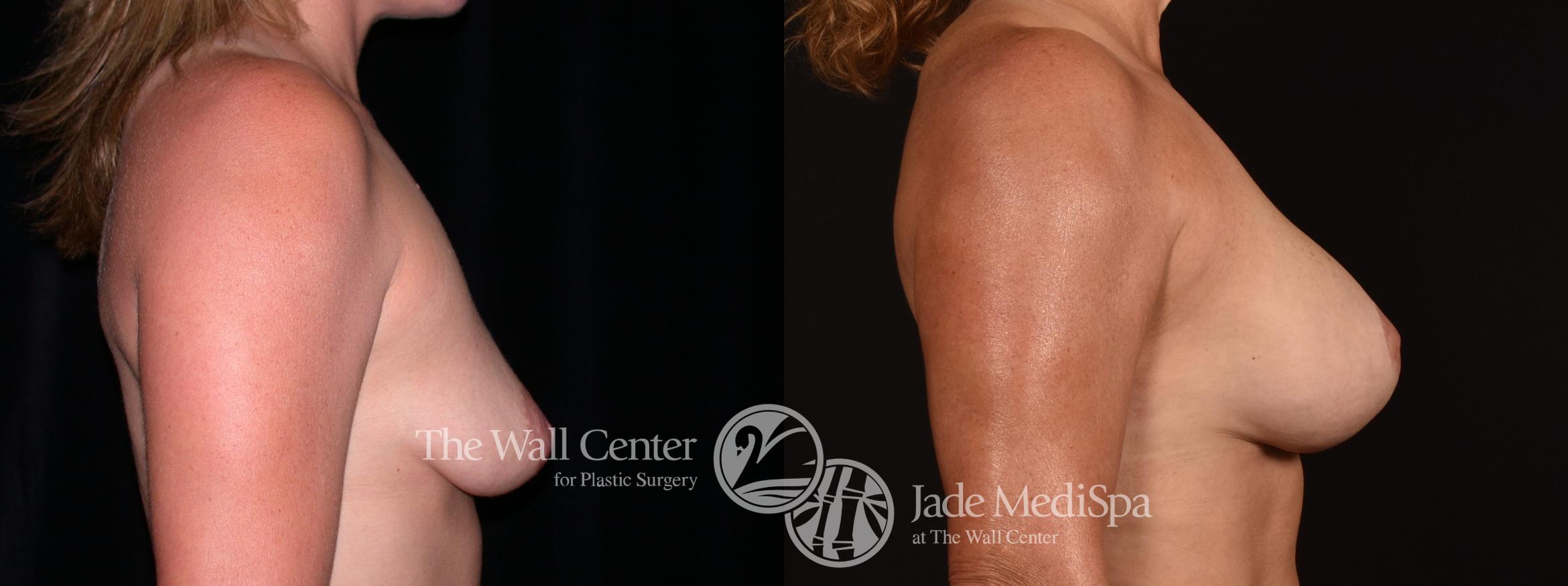 Before & After Breast Augmentation with Lift Case 1240 Right Side View in Shreveport, LA