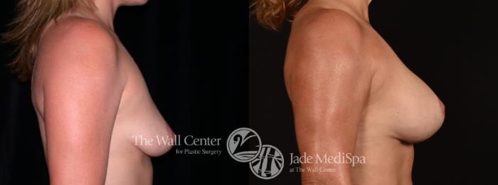 Before & After Breast Augmentation with Lift Case 1240 Right Side View in Shreveport, LA