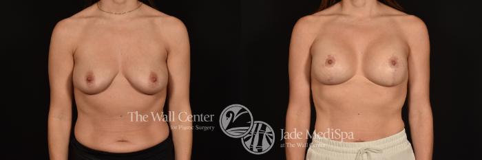 Before & After Breast Augmentation with Lift Case 1245 Front View in Shreveport, LA