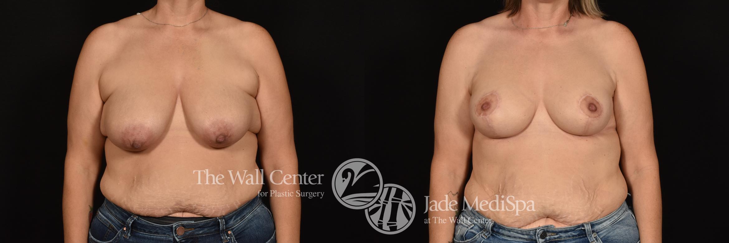 Before & After Breast Augmentation with Lift Case 1247 Front View in Shreveport, LA