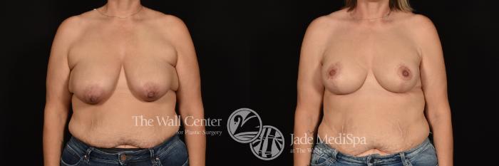 Before & After Breast Augmentation with Lift Case 1247 Front View in Shreveport, LA