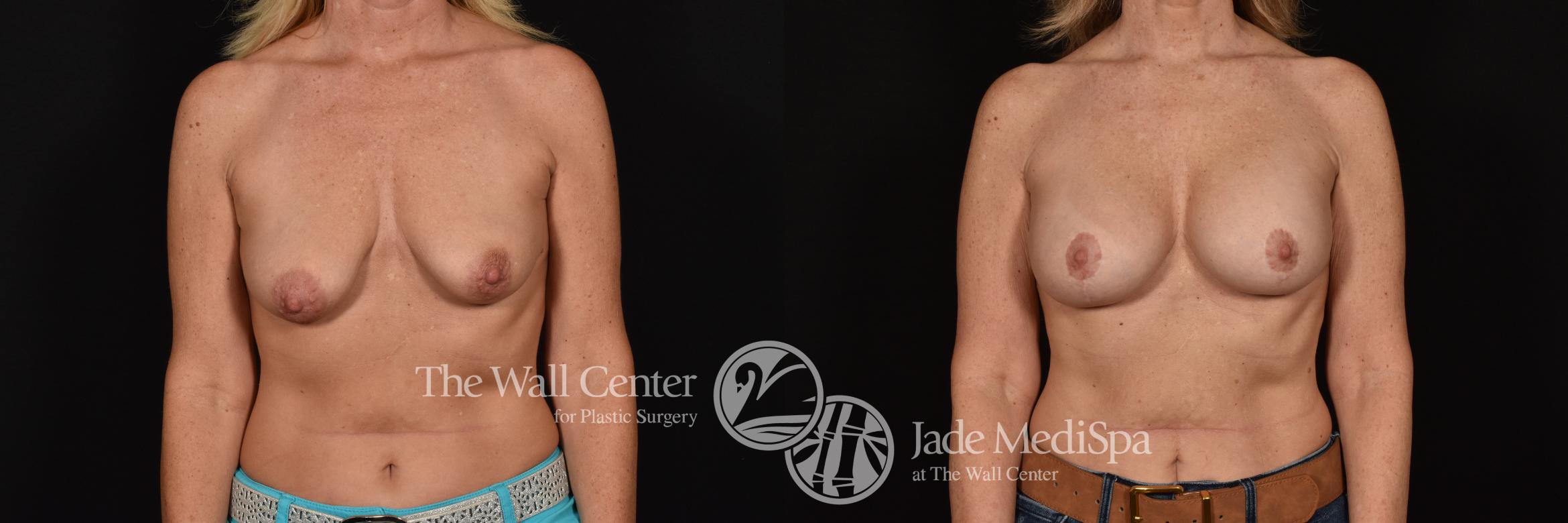 Before & After Breast Augmentation with Lift Case 1252 Front View in Shreveport, LA