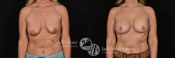 Before & After Breast Augmentation with Lift Case 1252 Front View in Shreveport, LA