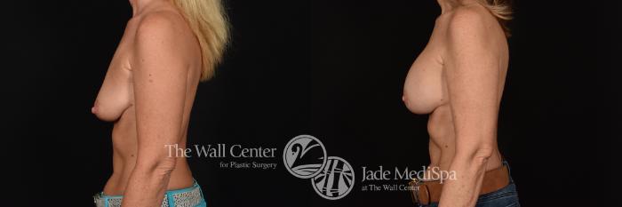 Before & After Breast Augmentation with Lift Case 1252 Left Side View in Shreveport, LA