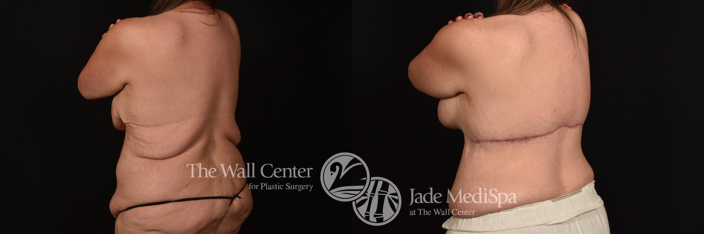 Before & After Breast Augmentation with Lift Case 1255 Back View in Shreveport, LA