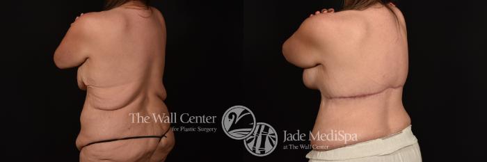 Before & After Breast Augmentation with Lift Case 1255 Back View in Shreveport, LA