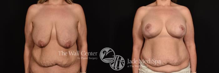 Before & After Breast Augmentation with Lift Case 1255 Front View in Shreveport, LA