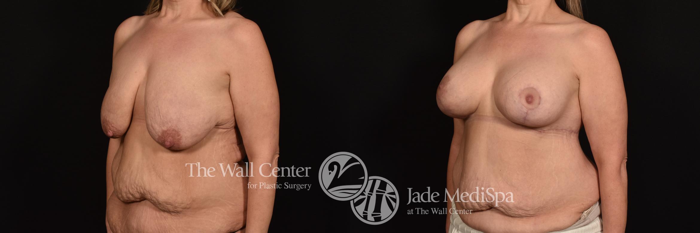 Before & After Breast Augmentation with Lift Case 1255 Left Oblique View in Shreveport, LA