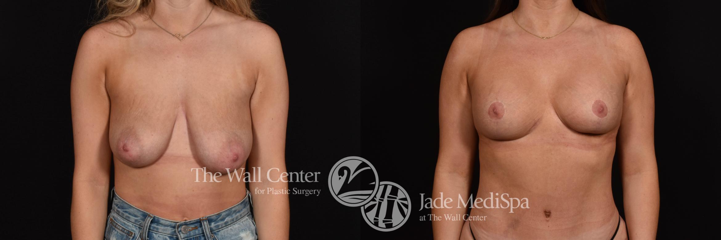 Before & After Breast Augmentation with Lift Case 1260 Front View in Shreveport, LA