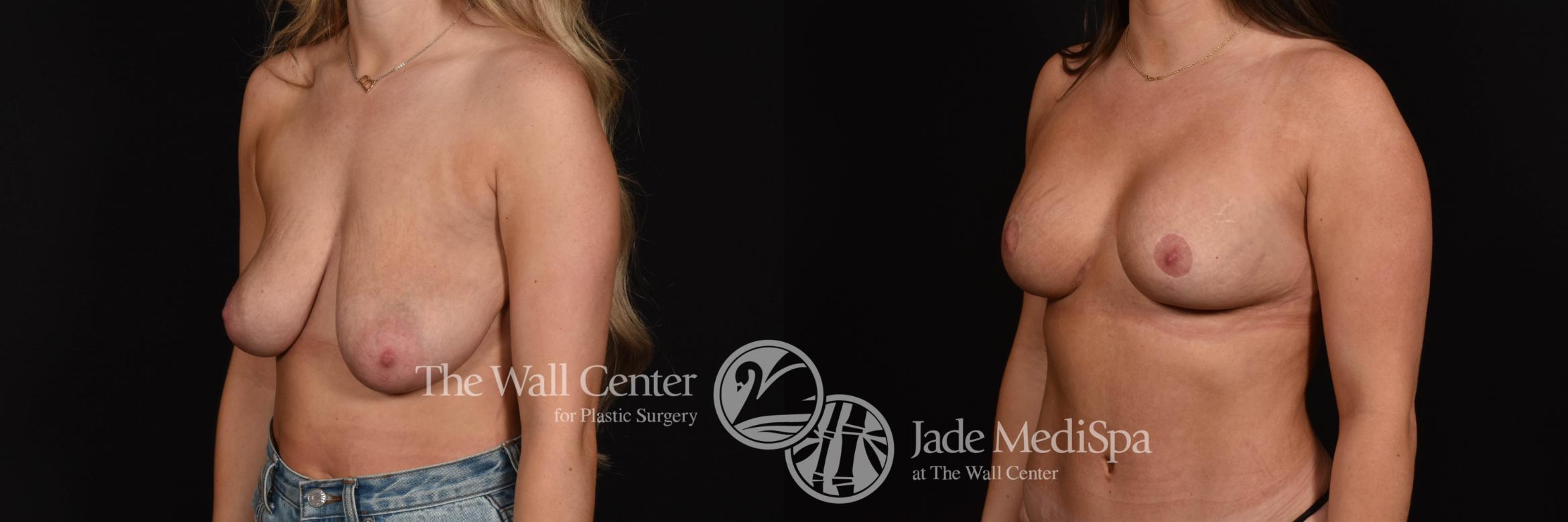 Before & After Breast Augmentation with Lift Case 1260 Left Oblique View in Shreveport, LA