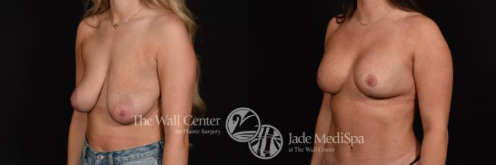 Before & After Breast Augmentation with Lift Case 1260 Left Oblique View in Shreveport, LA