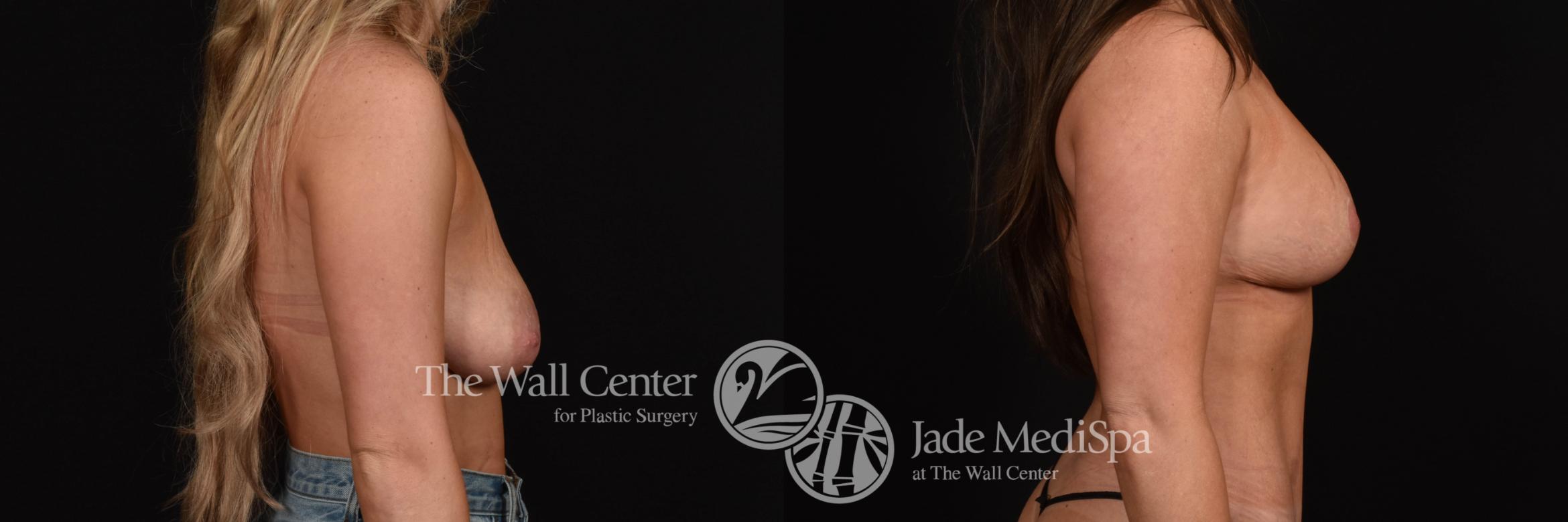 Before & After Breast Augmentation with Lift Case 1260 Right Side View in Shreveport, LA