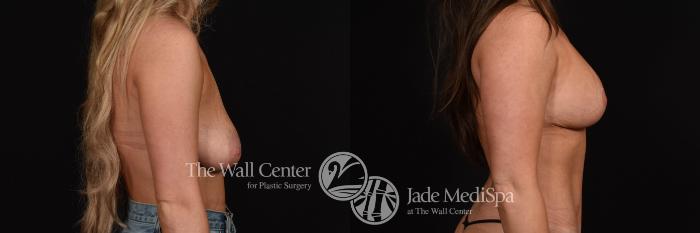 Before & After Breast Augmentation with Lift Case 1260 Right Side View in Shreveport, LA