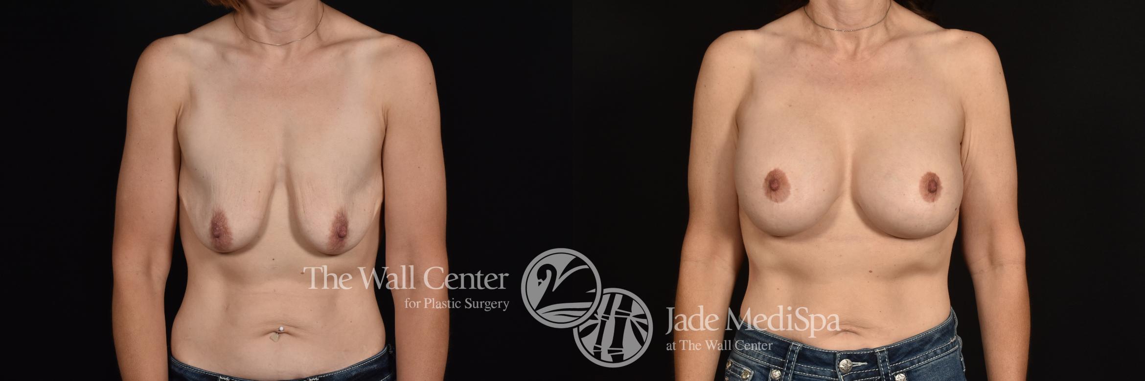 Before & After Breast Augmentation with Lift Case 1265 Front View in Shreveport, LA