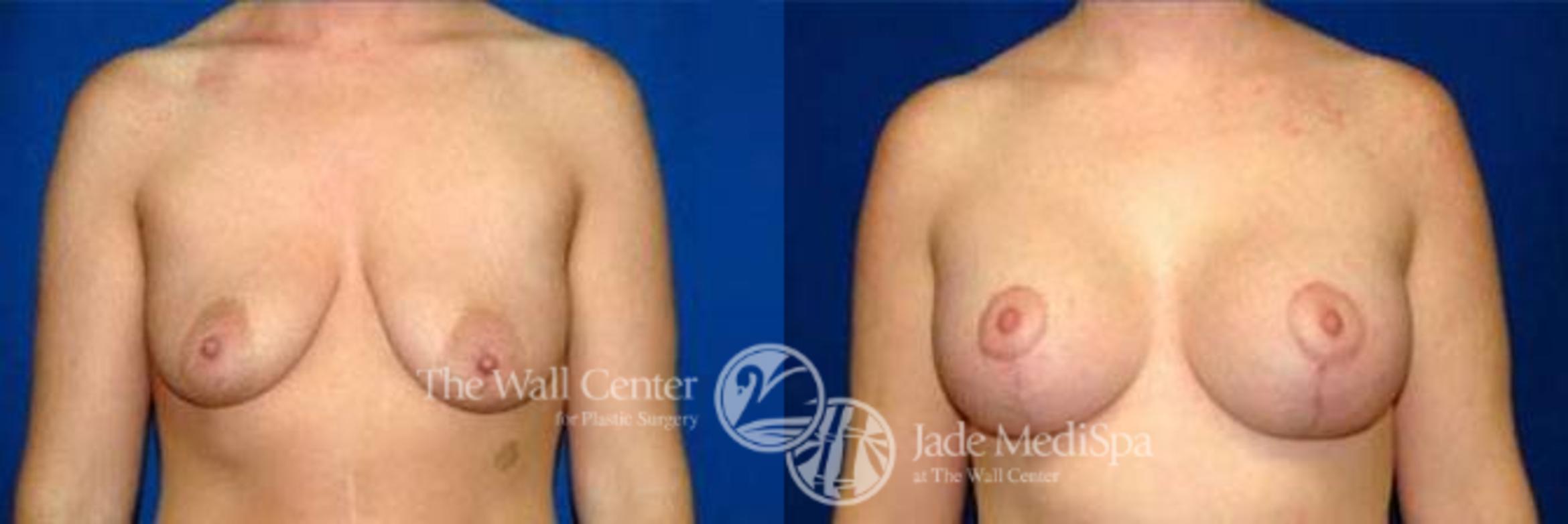 Before & After Breast Augmentation with Lift Case 127 View #1 View in Shreveport, LA