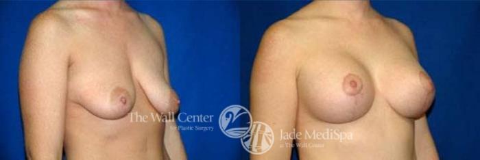 Before & After Breast Augmentation with Lift Case 127 View #2 View in Shreveport, LA
