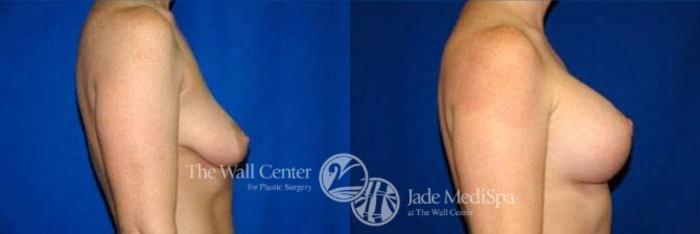 Before & After Breast Augmentation with Lift Case 127 View #3 View in Shreveport, LA