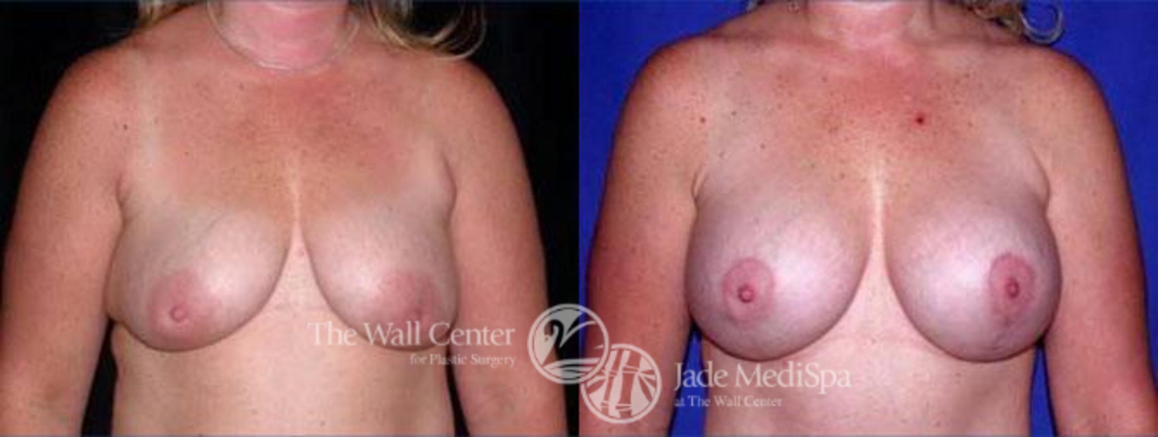 Before & After Breast Augmentation with Lift Case 130 View #1 View in Shreveport, LA