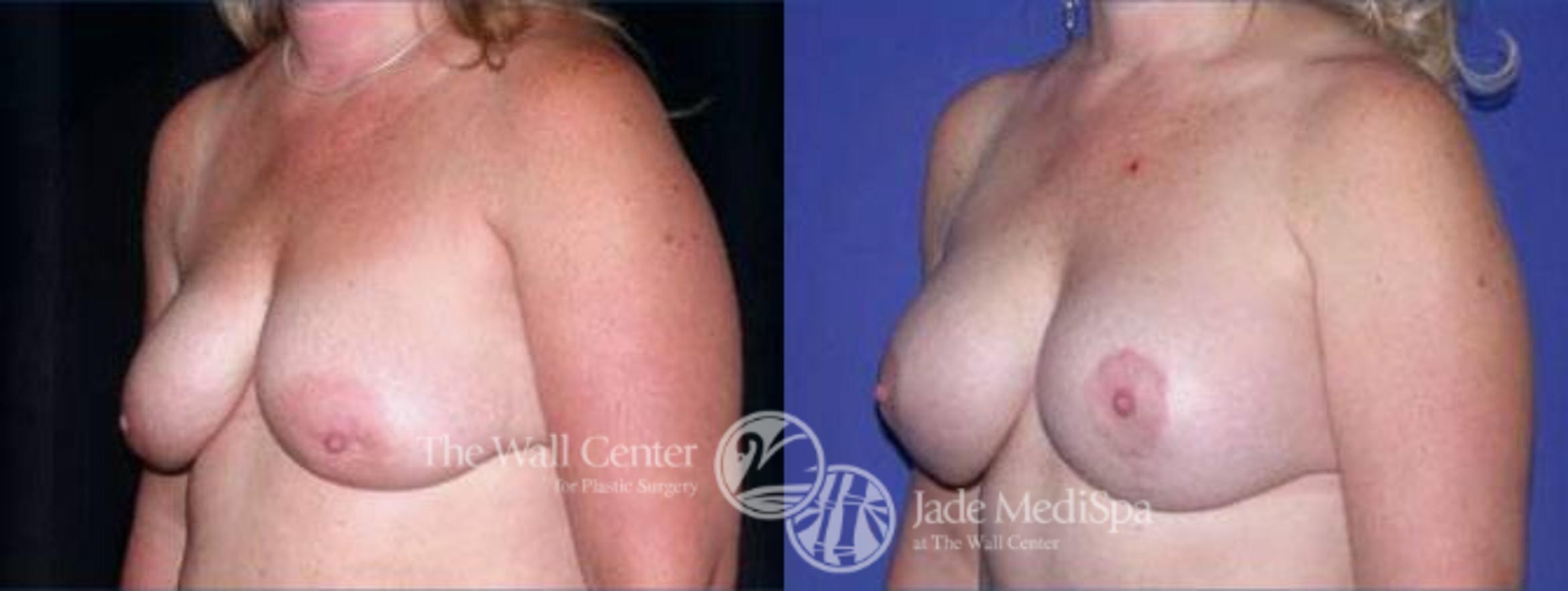 Before & After Breast Augmentation with Lift Case 130 View #2 View in Shreveport, LA