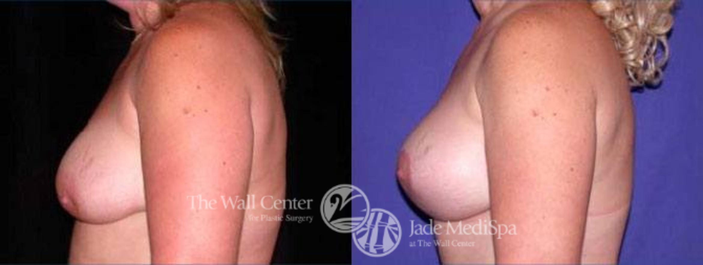 Before & After Breast Augmentation with Lift Case 130 View #3 View in Shreveport, LA