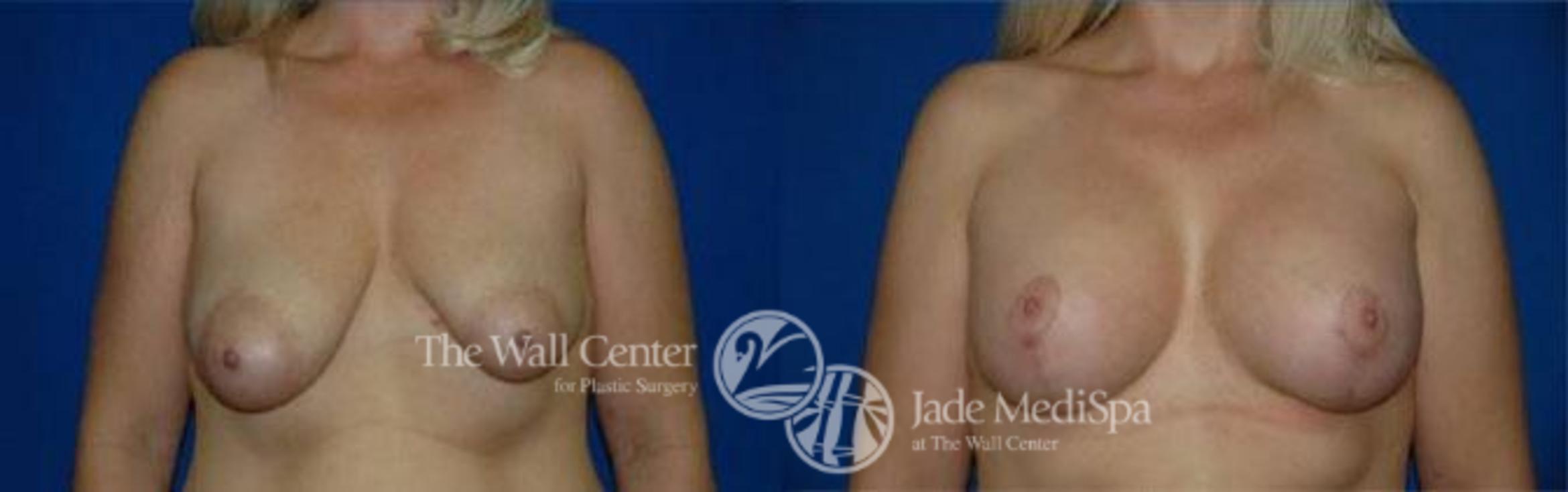 Before & After Breast Augmentation with Lift Case 131 View #1 View in Shreveport, LA