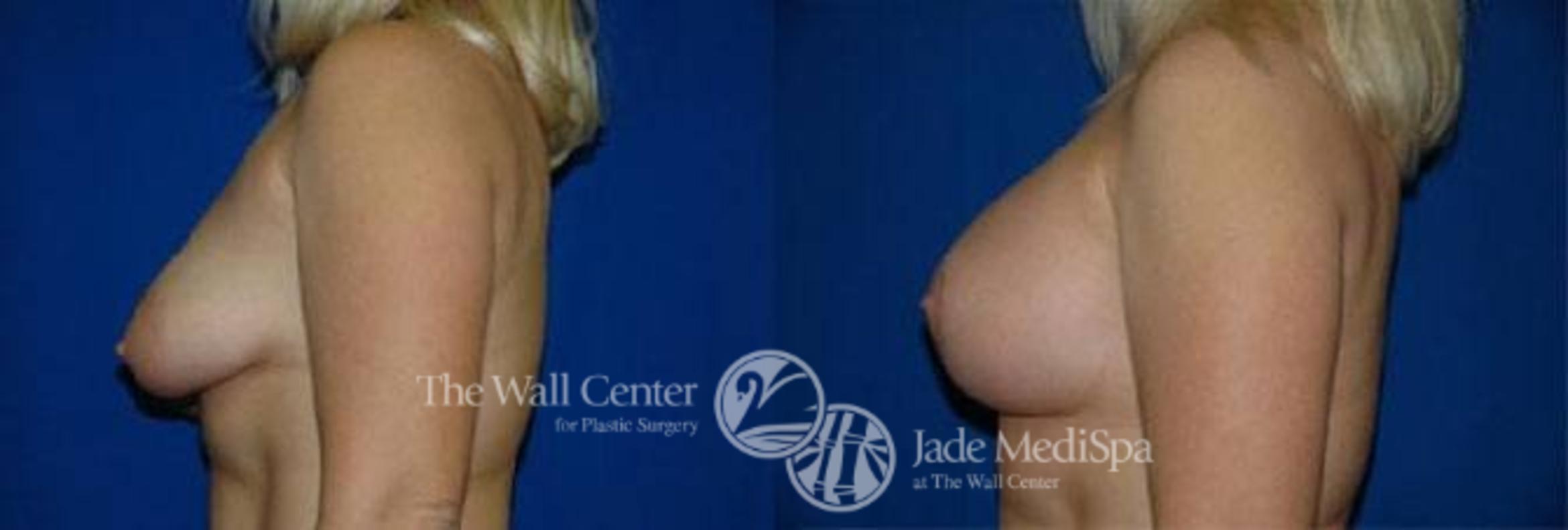 Before & After Breast Augmentation with Lift Case 131 View #3 View in Shreveport, LA
