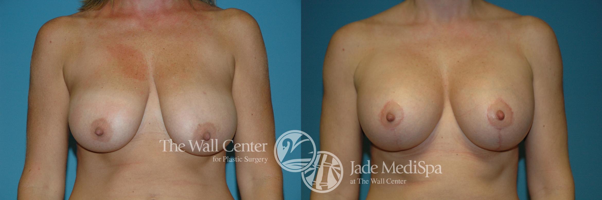 Before & After Breast Augmentation with Lift Case 194 View #1 View in Shreveport, LA