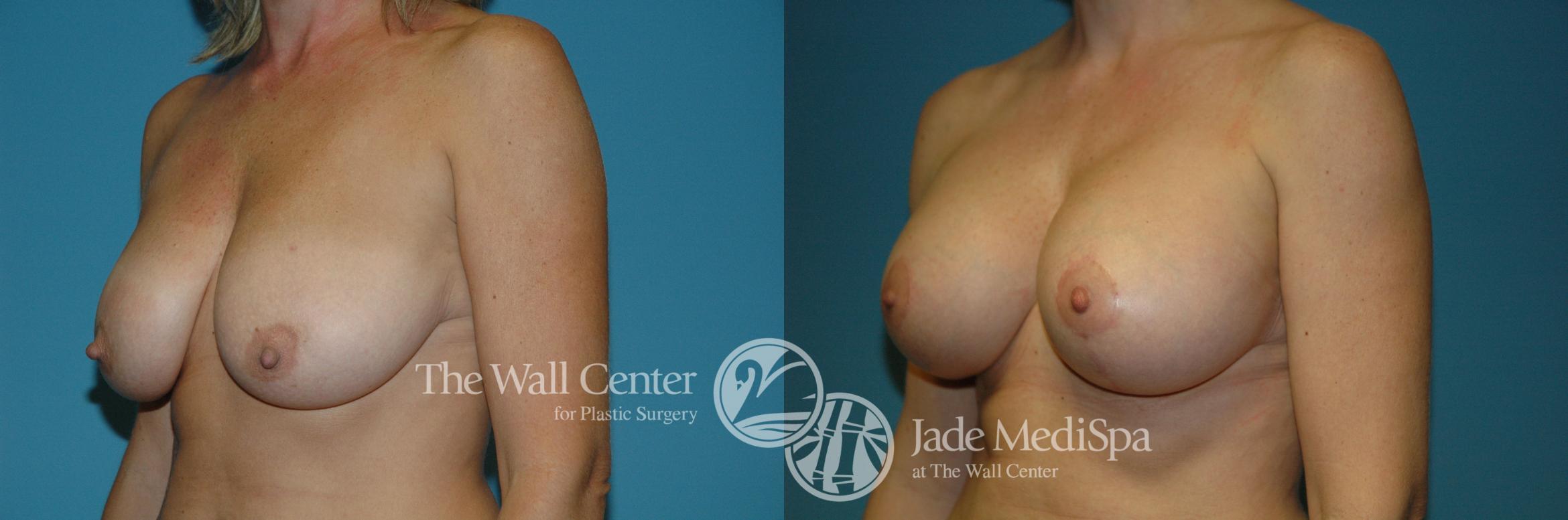 Before & After Breast Augmentation with Lift Case 194 View #2 View in Shreveport, LA