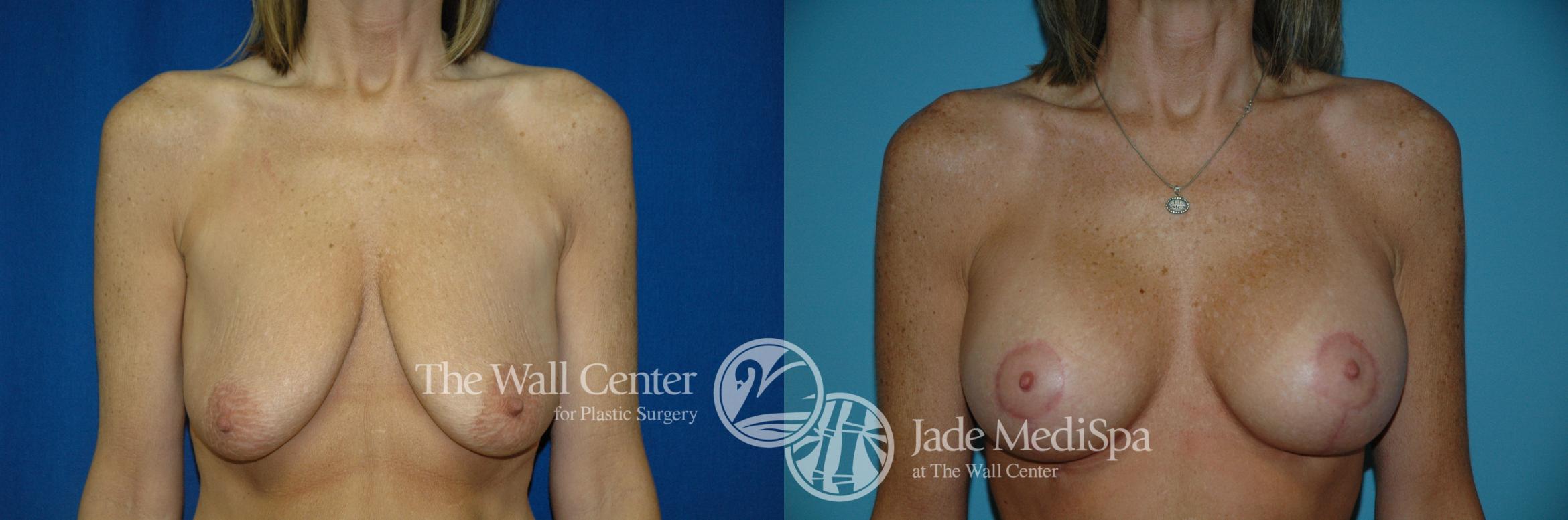 Before & After Breast Augmentation with Lift Case 195 View #1 View in Shreveport, LA