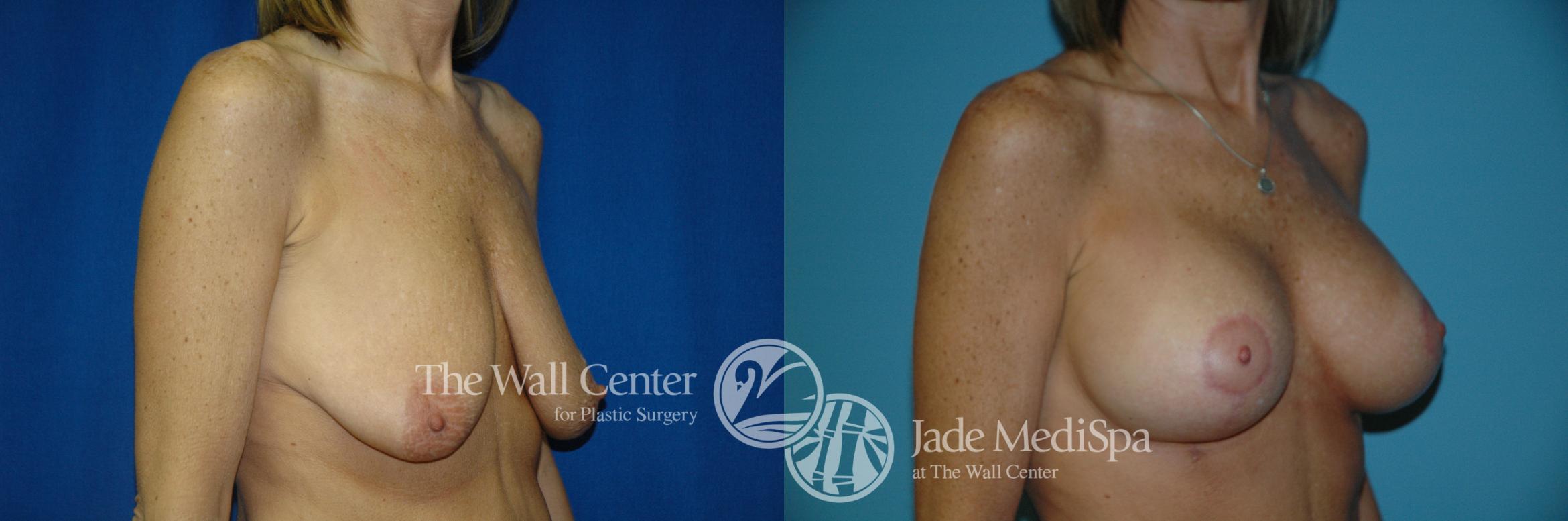 Before & After Breast Augmentation with Lift Case 195 View #2 View in Shreveport, LA