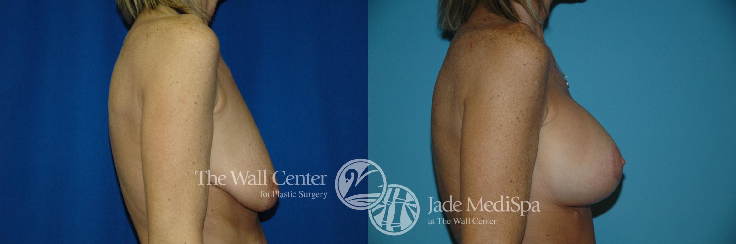 Before & After Breast Augmentation with Lift Case 195 View #3 View in Shreveport, LA