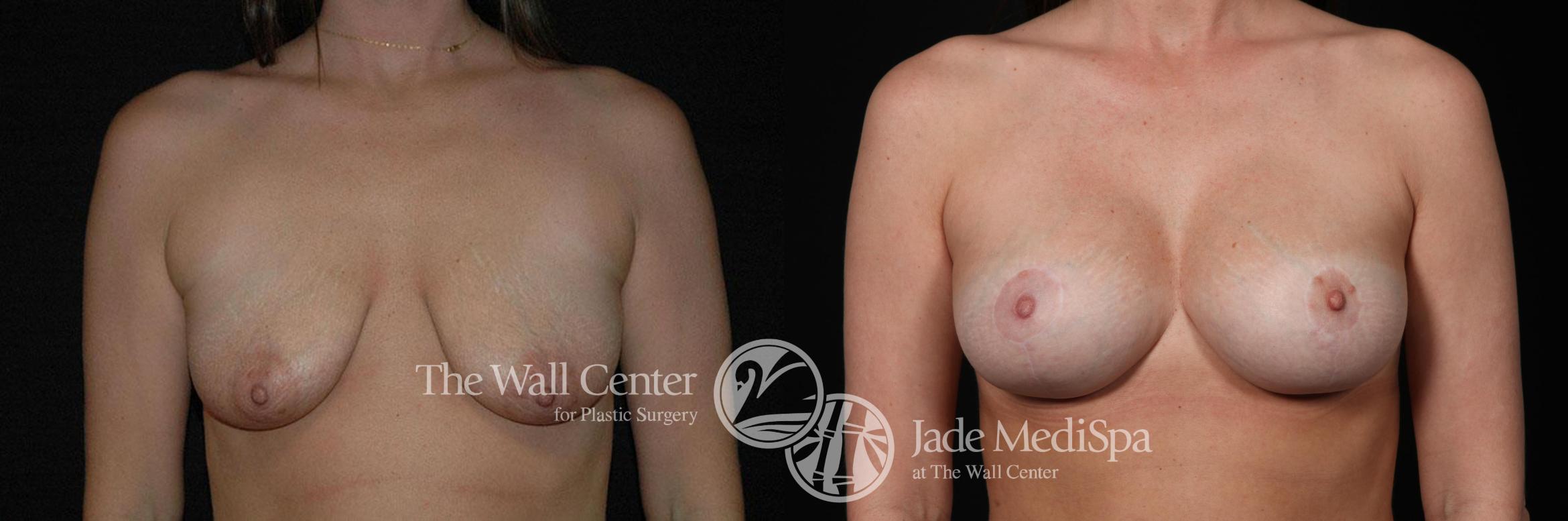Before & After Breast Augmentation with Lift Case 256 View #1 View in Shreveport, LA