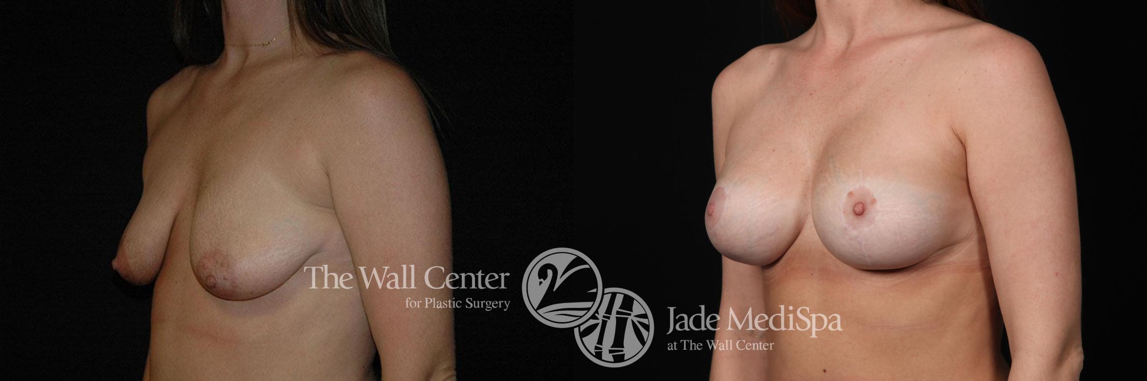Before & After Breast Augmentation with Lift Case 256 View #2 View in Shreveport, LA